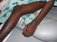 Atopic dermatitis and prurigo nodularis